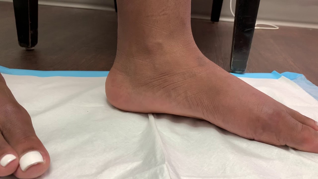 PERFORMED MINIMALLY INVASIVE HYPROCURE SURGERY FOR FLAT FEET 🥰🥰🥰