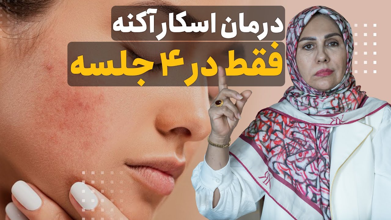 درمان اسکار آکنه فقط در ۴ جلسه | انواع اسکار آکنه و شیوه درمان آن