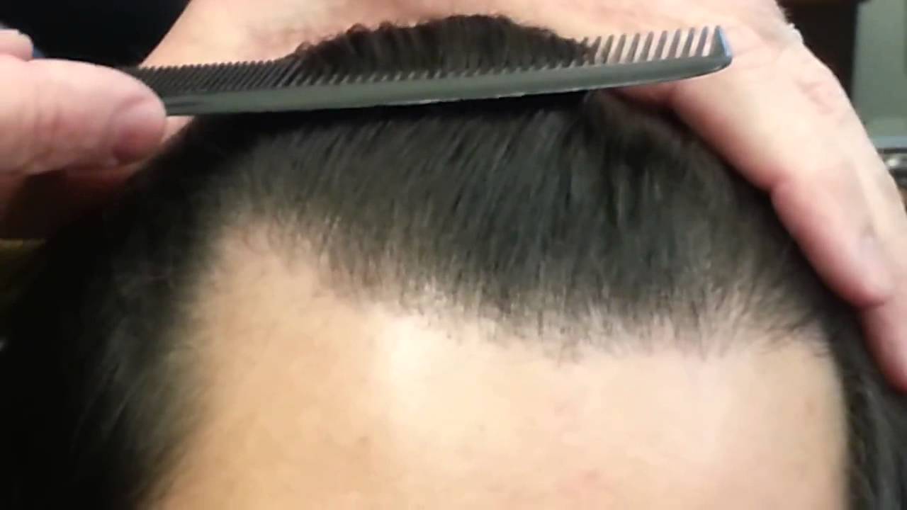 Hair Transplant hair line results by Dr  Dan McGrath, Austin, Texas