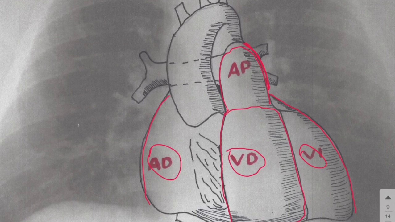 Interpretación de la silueta cardiaca en el Rx torax AP