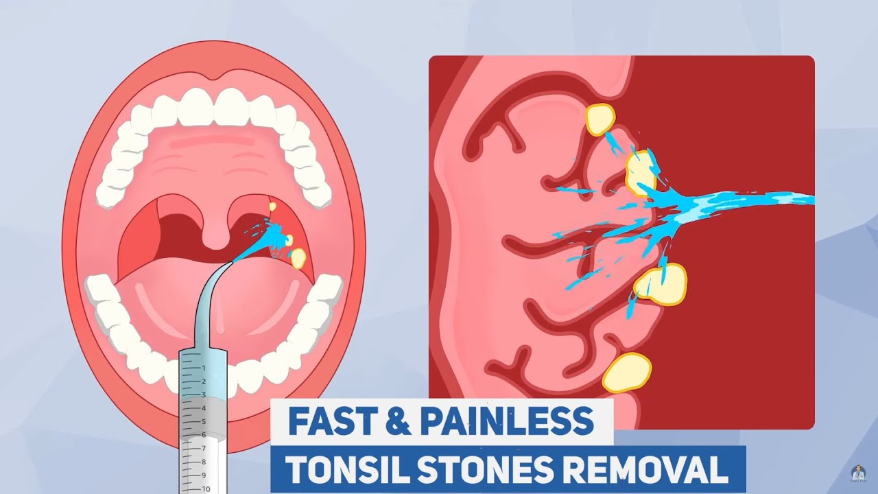 NEW Dr. Frederick's Original Easy Tonsil Stone Removal Kit
