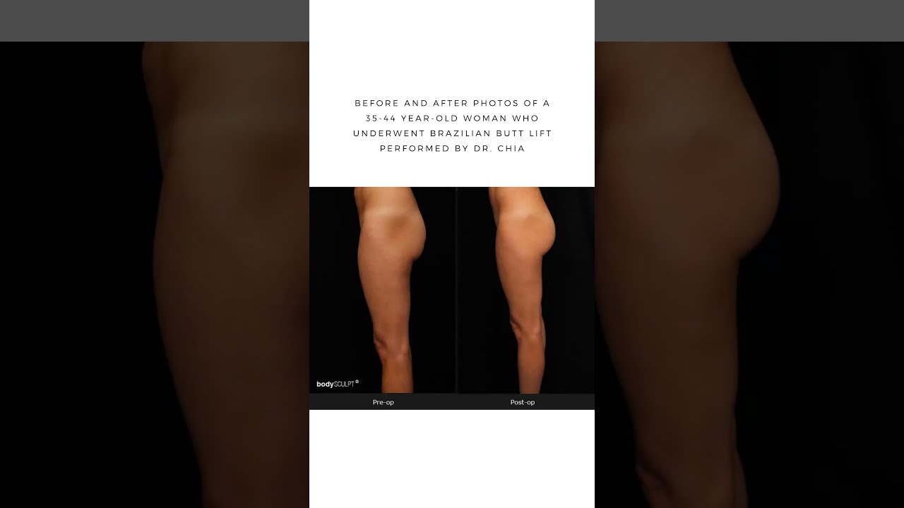 Brazilian Butt Lift - Before and After