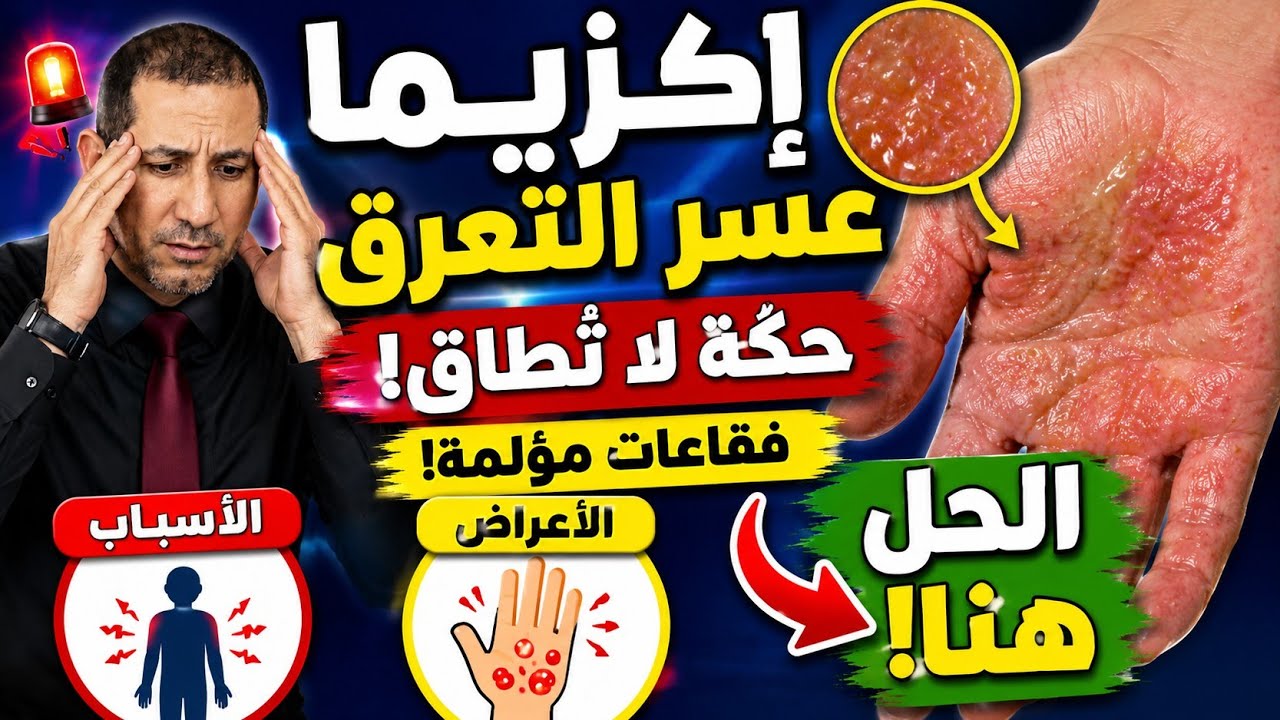 إكزيما خلل التعرق - عسر التعرق 🤔 الاسباب والاعراض  📝 وروشتة العلاج 👌 👍