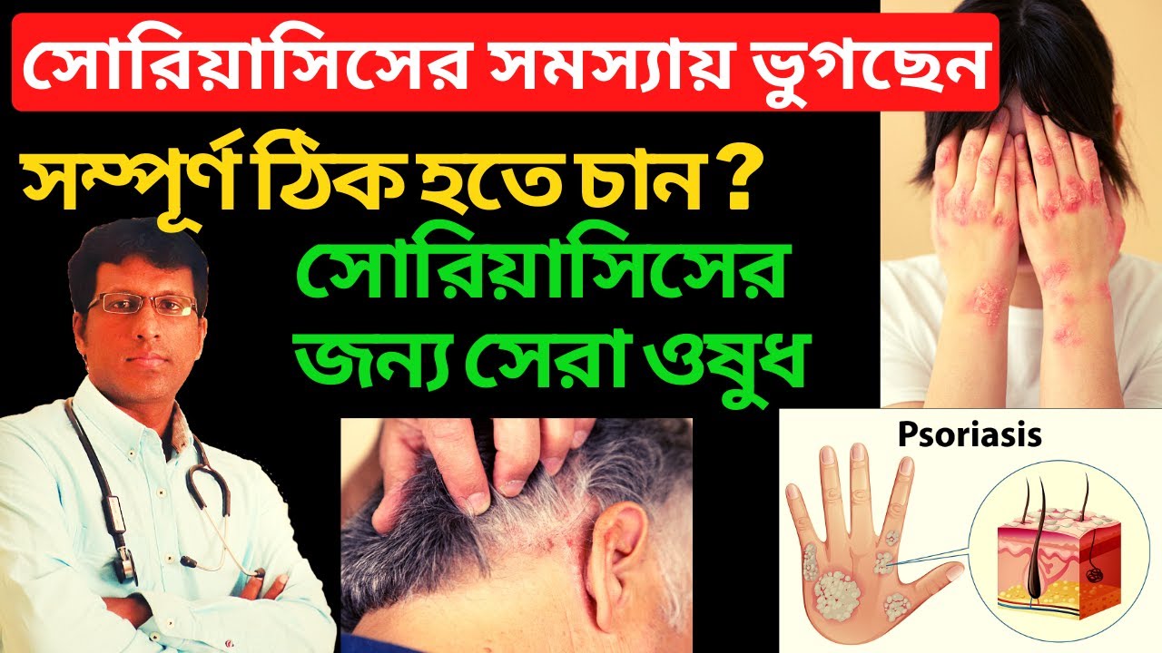 Best Homeopathy medicine for psoriasis Psoriasis treatment In Bangla সোরিয়াসিসের জন্য সেরা ওষুধ