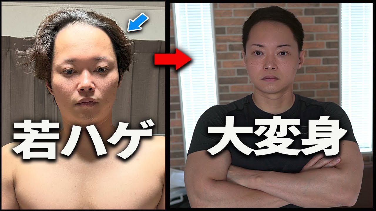 【薄毛・はげ必見】ハゲでもかっこよくなる髪型がこれです！おでこが広い人必見！