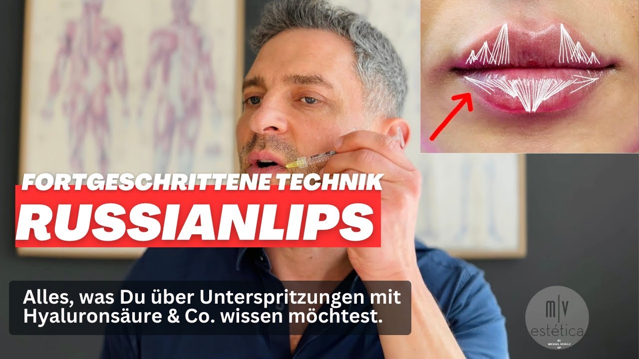 Russian Lips: Lippenunterspritzung mir Hyaluron.
