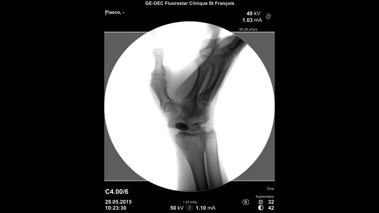L&rsquo;implant APSI, indications et r&eacute;sultats #video2