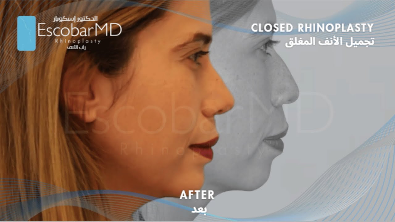 Before After | Ethnic Nose in Dubai | Closed Scarless Ethnic Rhinoplasty with Chin Implant