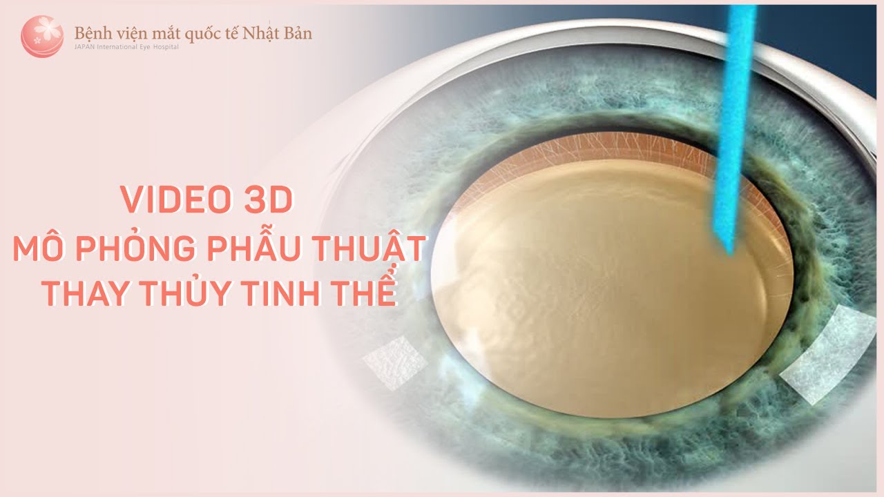 Video 3D mô phỏng phẫu thuật thay thủy tinh thể | Cataract Surgery 3D Animation