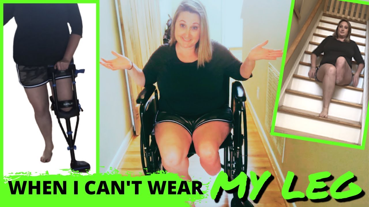 Amputee Can’t Wear Prosthetic Leg | what now?