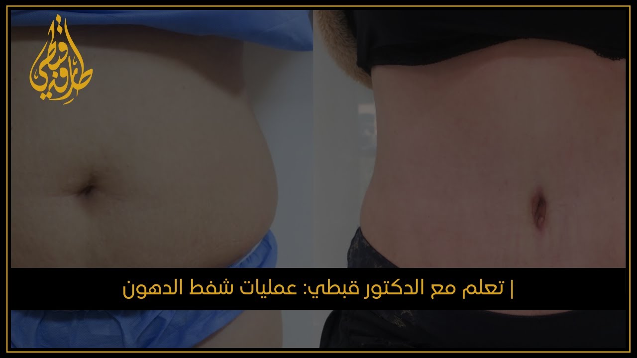 الدكتور طارق قبطي للتجميل  | تعلم مع الدكتور قبطي: عمليات شفط الدهون