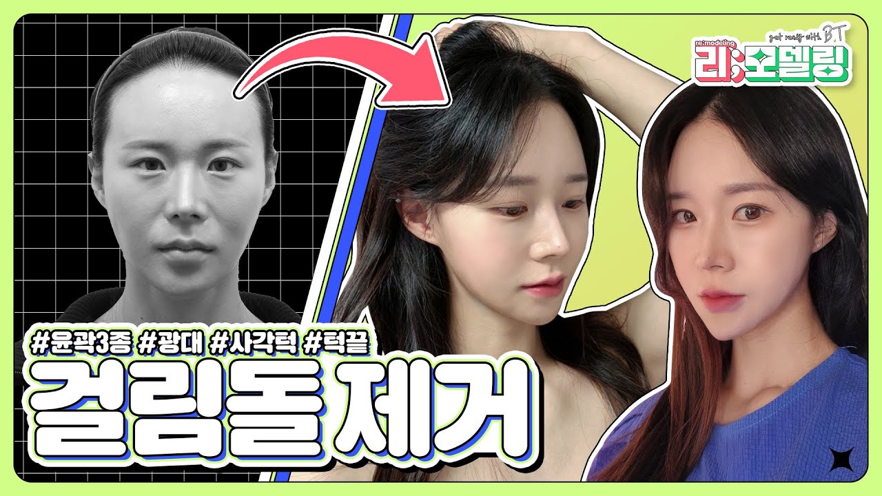 윤곽3종(광대/사각턱/턱끝) 후기 브이로그ㅣ비티성형외과