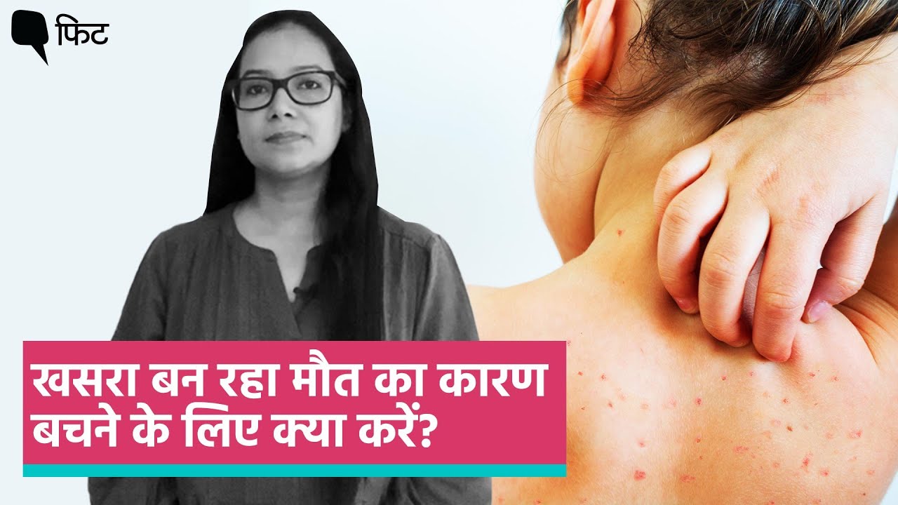 Measles In India: खसरे के फैलने से हो रही मौतें, ये हैं बचने के उपाय| Measles outbreak 2022 ।Quint