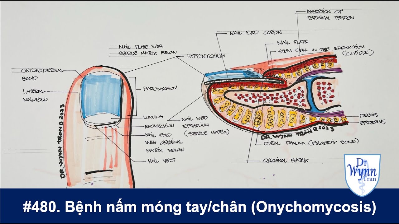 #480. Bệnh nấm móng tay móng chân (Tinea Unguium/Onychomycosis)