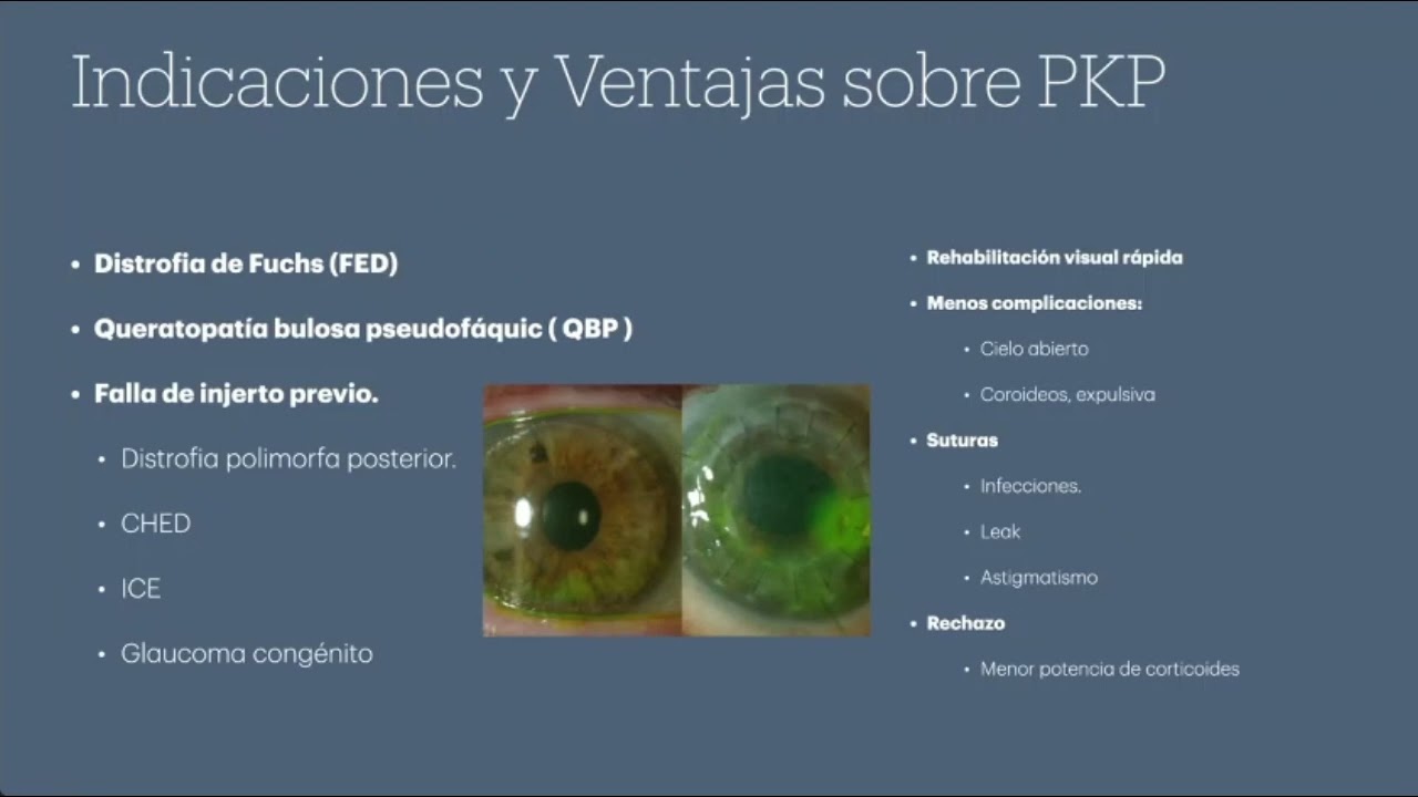 DMEK vs DSAEK  Dr  Andrés Contreras