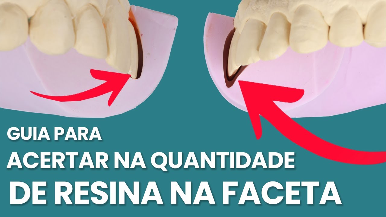 GUIA PARA ACERTAR NA QUANTIDADE DE RESINA NA FACETA   Mylene e Renato