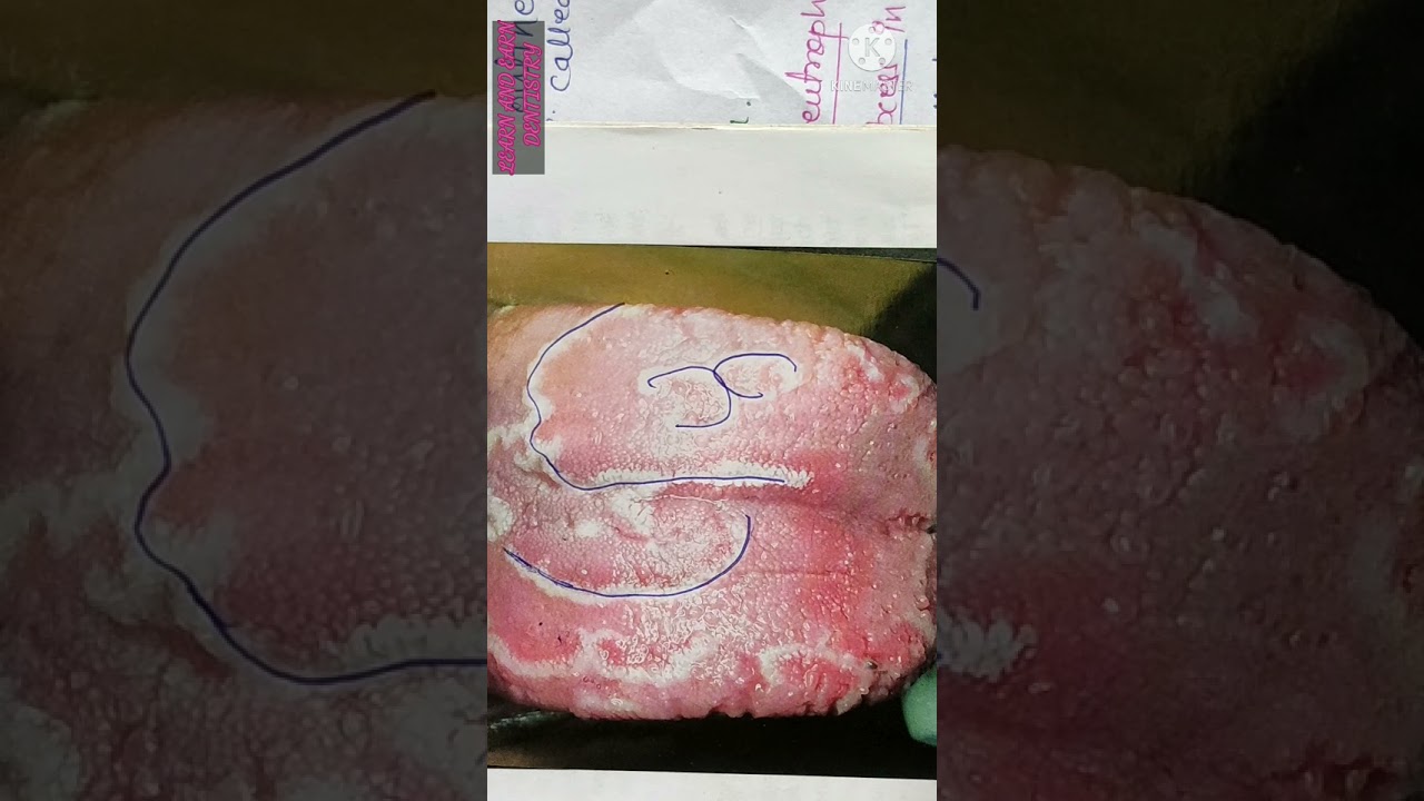BENIGN MIGRATORY GLOSSITIS