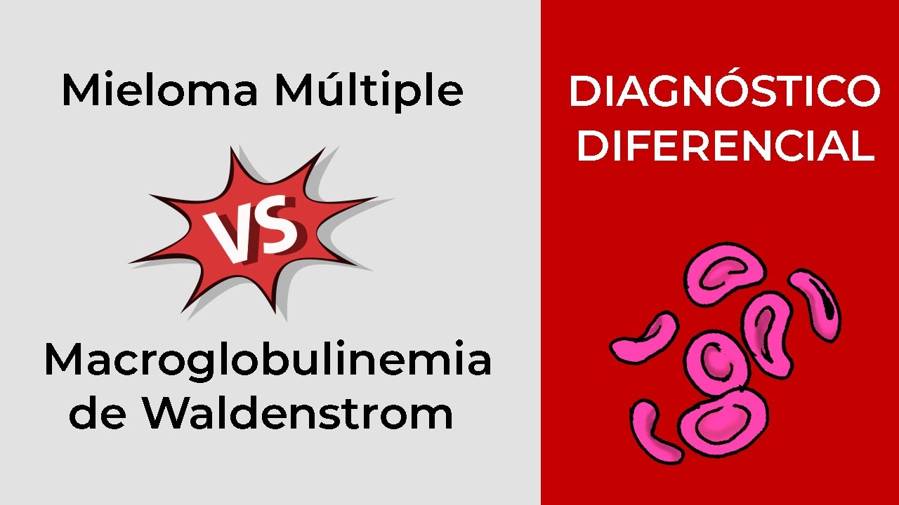 Diagnóstico Diferencial. Mieloma Múltiple vs Macroglobulinemia de Waldenstrom
