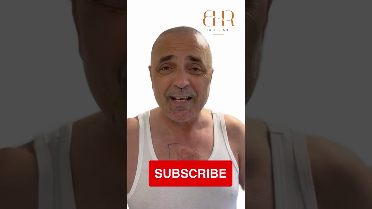 ✅ Finally Showing Your Insane Hair Transplant Transformation With Scalp And Body Hair 