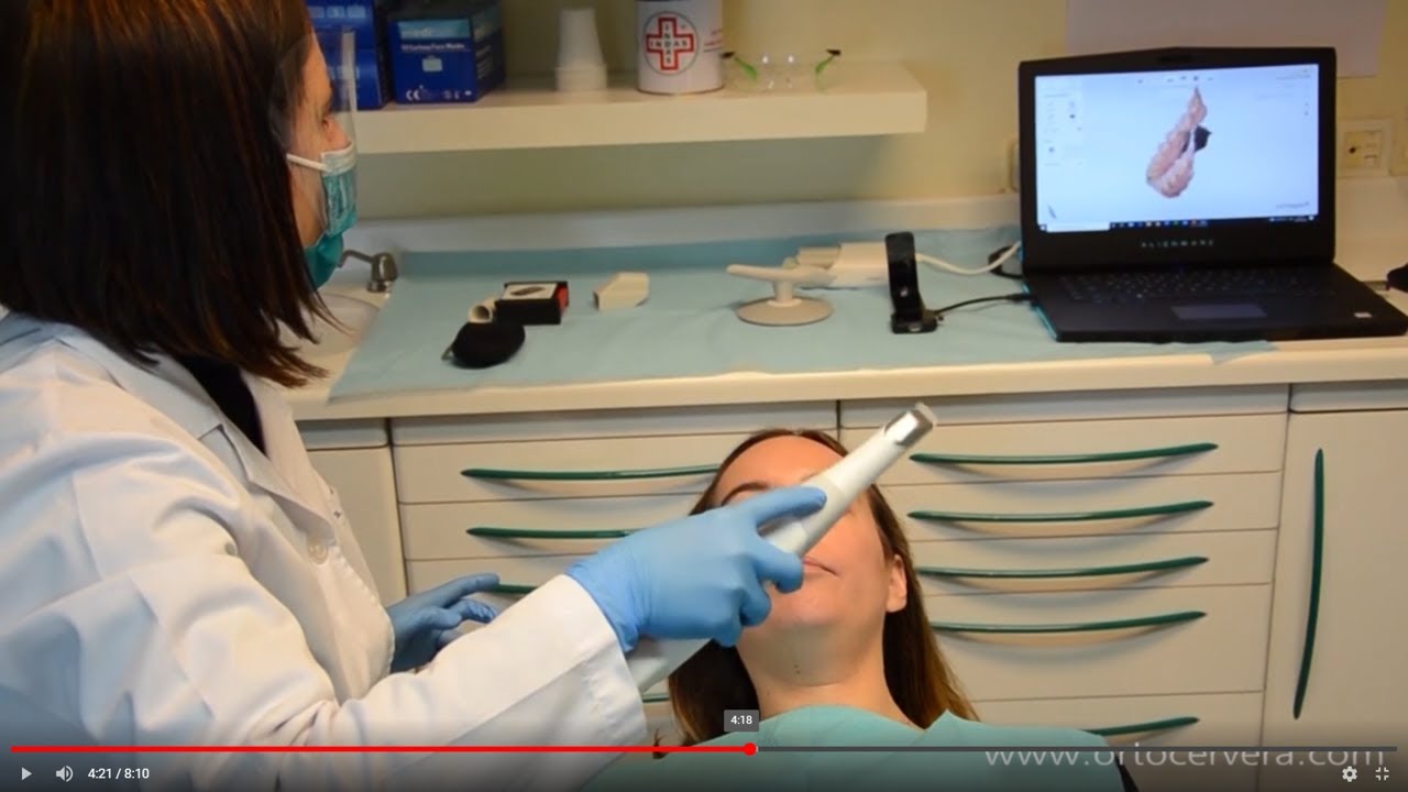 ORTOCERVERA/Ortodoncia: Escaneado Intraoral para Alineadores