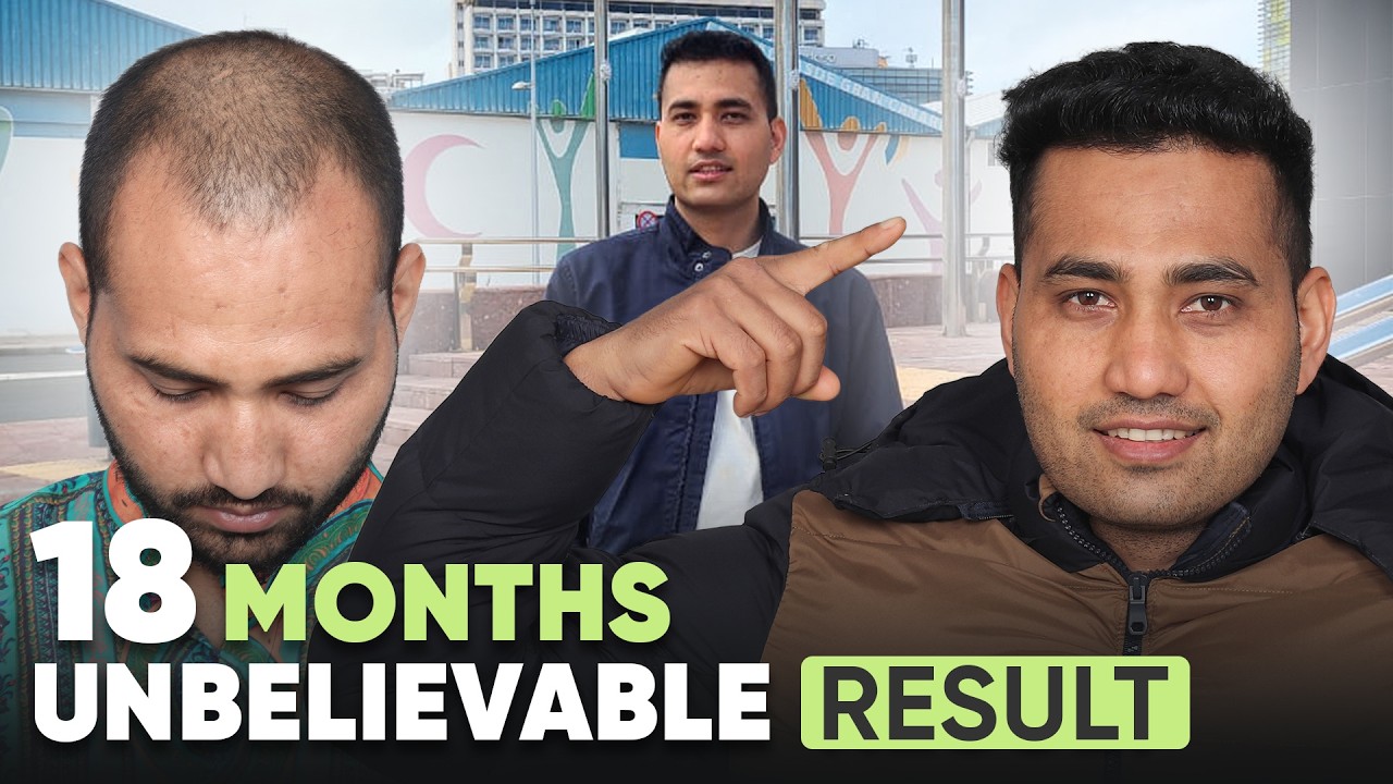 Hair Transplant in Kanpur (HX-CFGH) | Best Results & Cost of Hair Transplant in Kanpur.