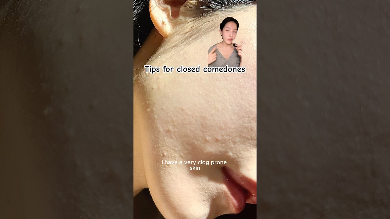 Getting rid of closed comedones #shorts