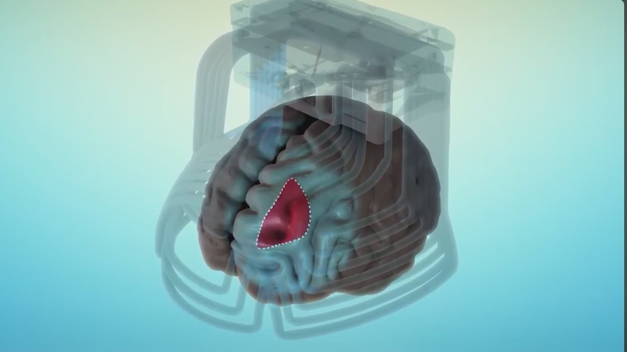 TMS (transcranial magnetic stimulation): Treatment for depression/anxiety