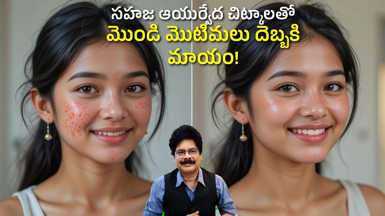 మొటిమలను మట్టుబెట్టే ఖర్చు లేని సహజ చికిత్సలు. No cost Natural Home Remedies for Acne by Dr. Murali