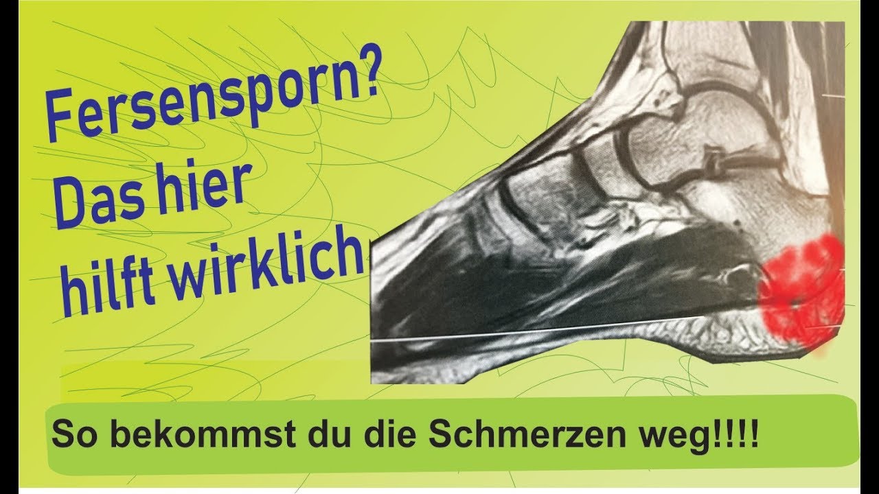 Fersensporn? So bekommst du ihn in Griff