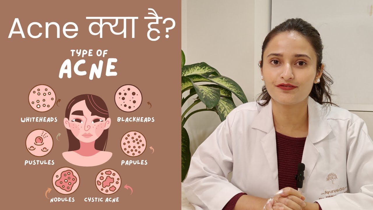 What is Acne? | Types Of Acne | Acne Treatment