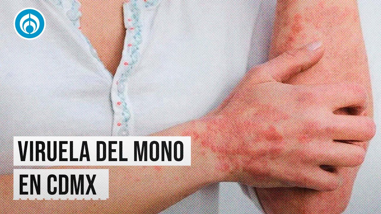 Segundo caso de viruela del mono en CDMX