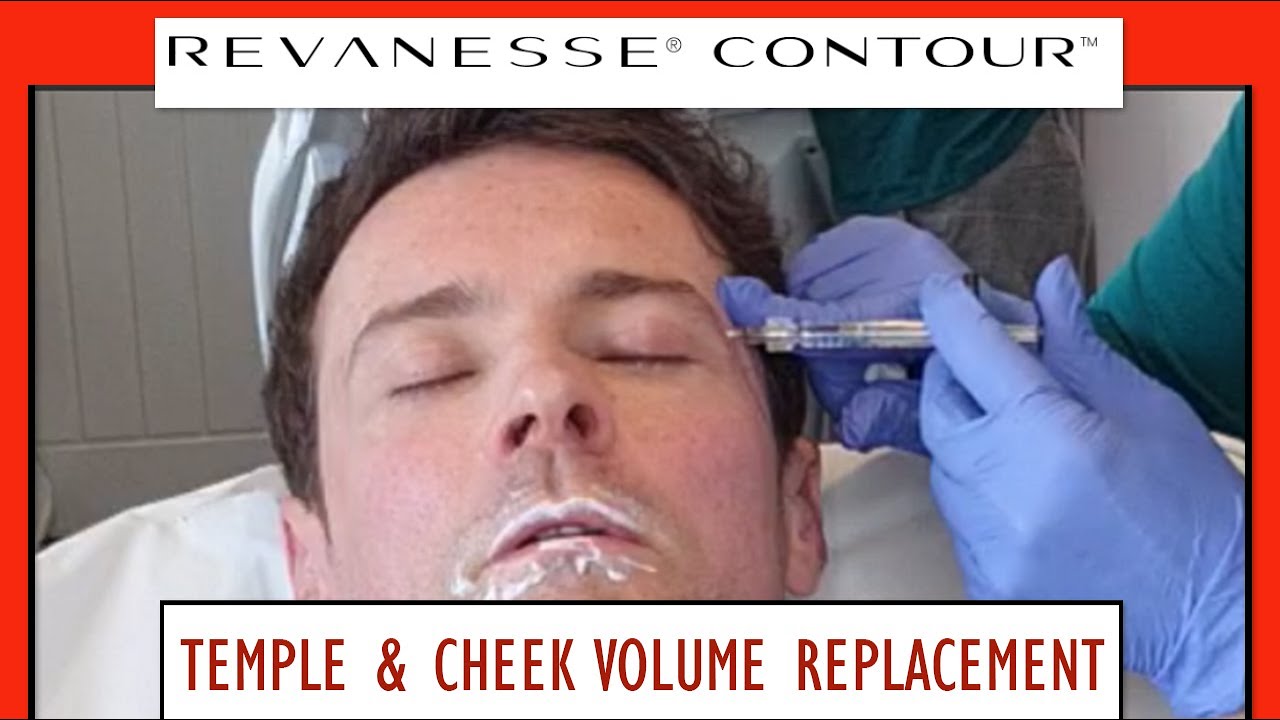 Facial Volume Replacement with Revanesse Filler - temples, cheek & lips