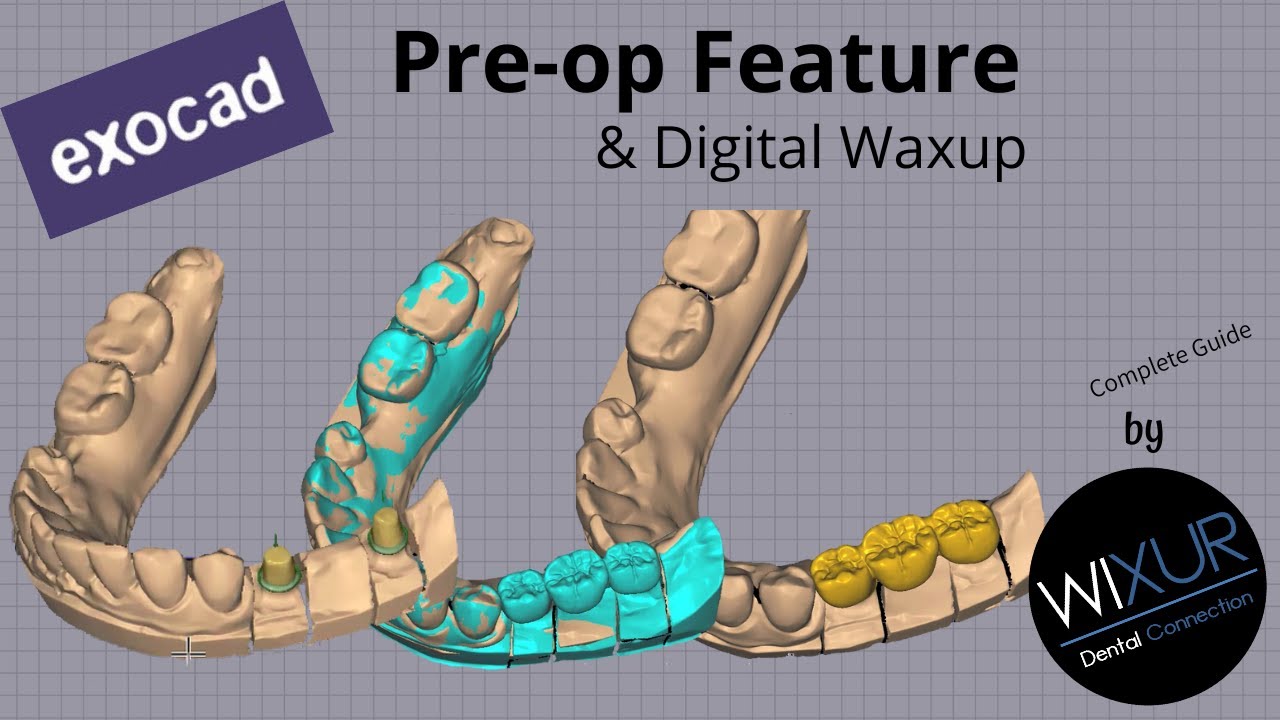 exocad Pre-op Feature (Digital Waxup)
