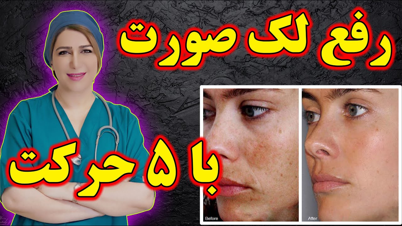 لک صورت را چگونه برطرف کنیم؟ سریعترین درمان لک صورت چیست؟