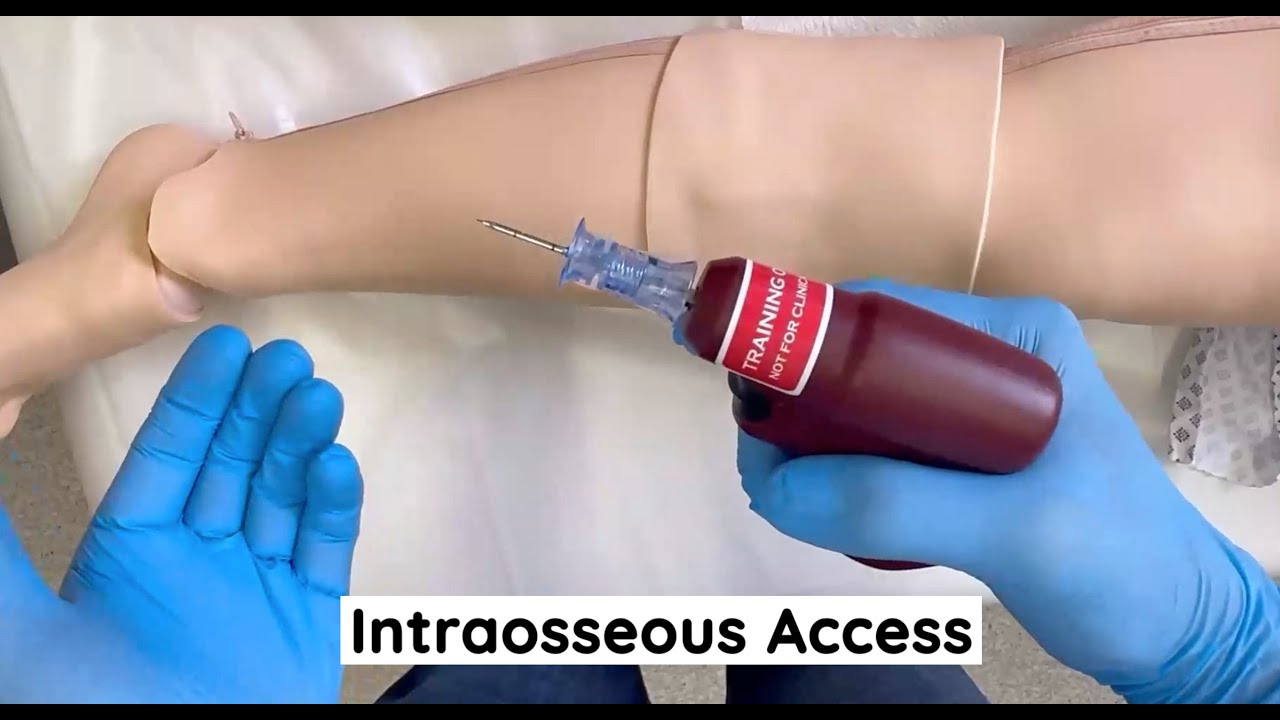 Intraosseous access