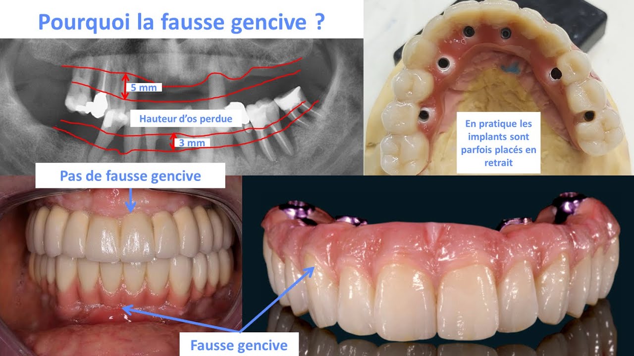 Fausse gencive pour prothèse fixe sur implant dentaire