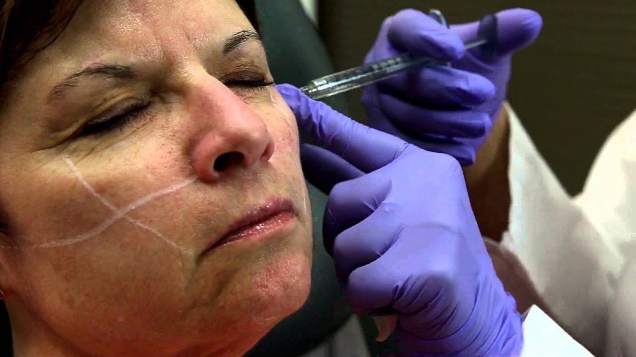 Dr. Alicia Zalka exhibits Juvéderm Voluma™ XC