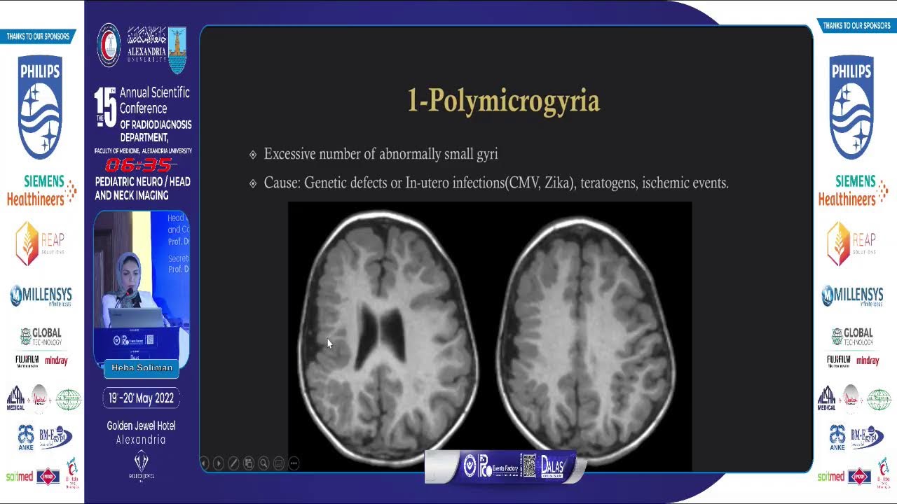 Malformations of Cortical Development: Recent Classification and Updated Guidelines