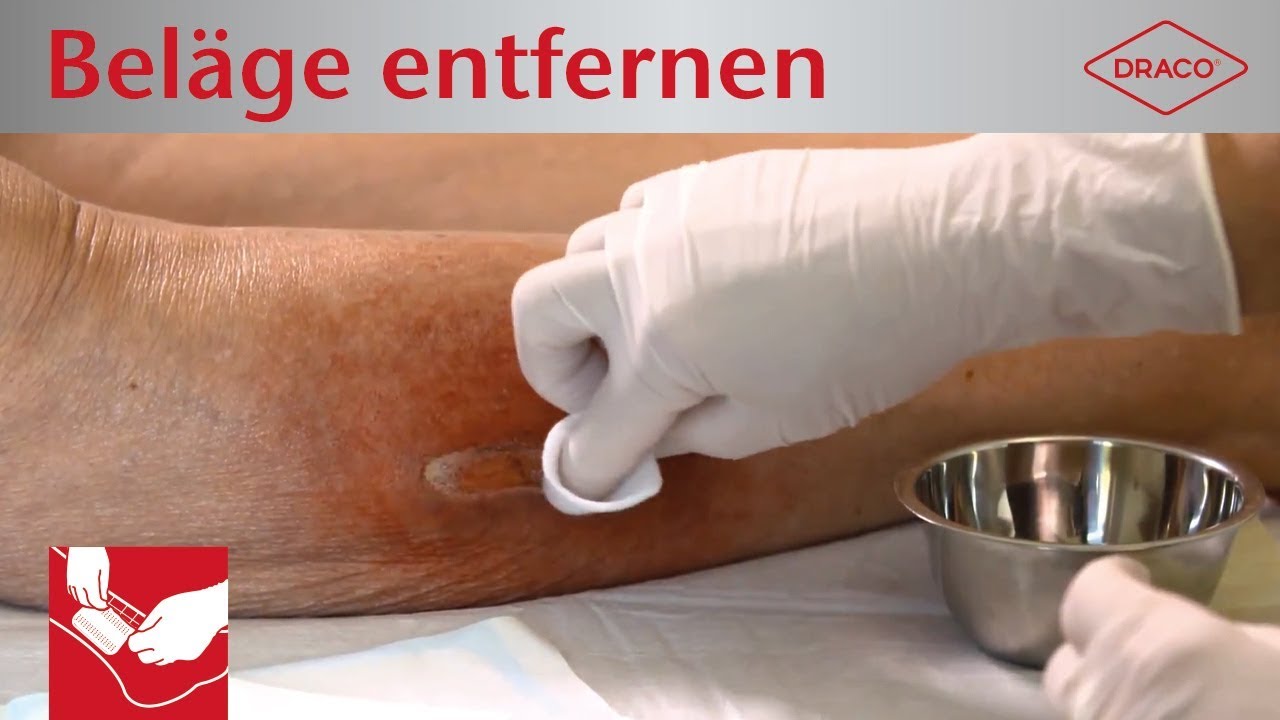 Wundreinigung: Bel&auml;ge entfernen bei chronischen Wunden - Biofilm, Fibrinbelag, Nekrose