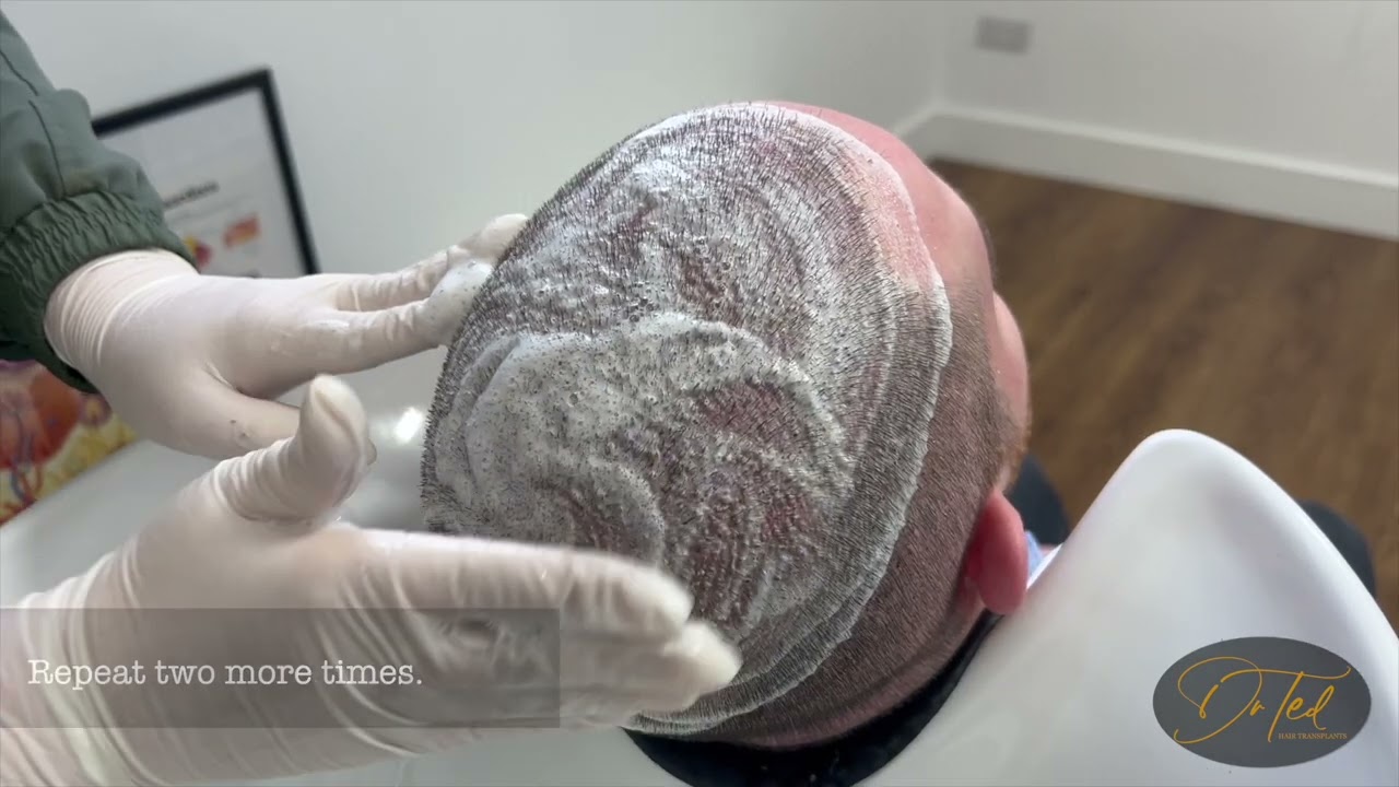 Dr Ted Hair Transplants 7 Day Contact Hair Wash Instructions