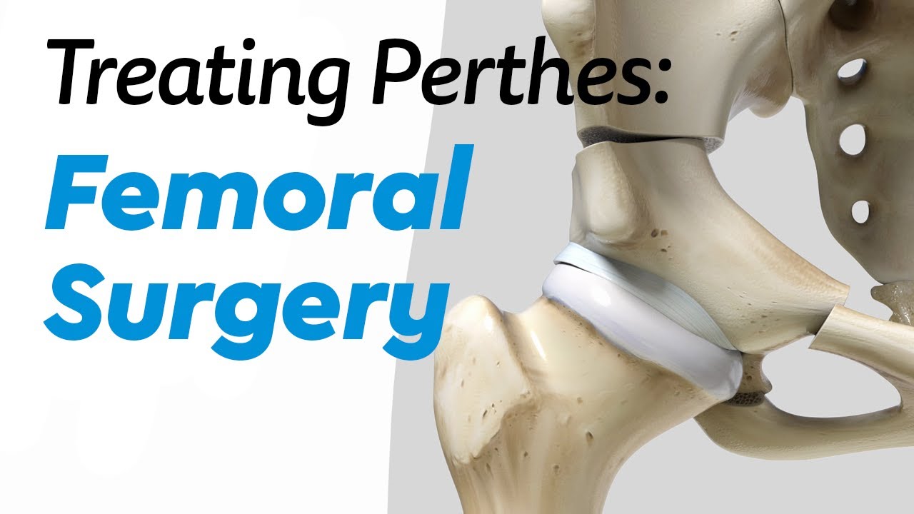 Femoral Surgery for Treating Perthes Disease in Children