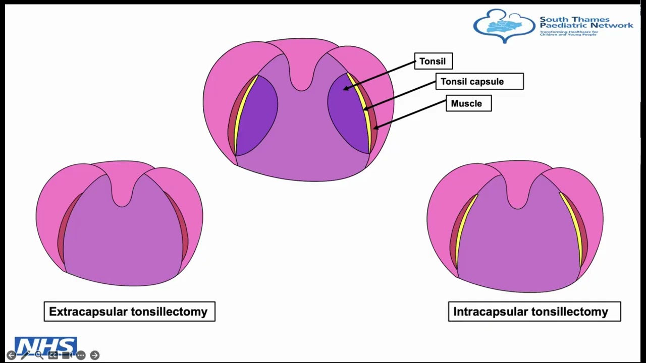 STPN Tonsillectomy Pathway