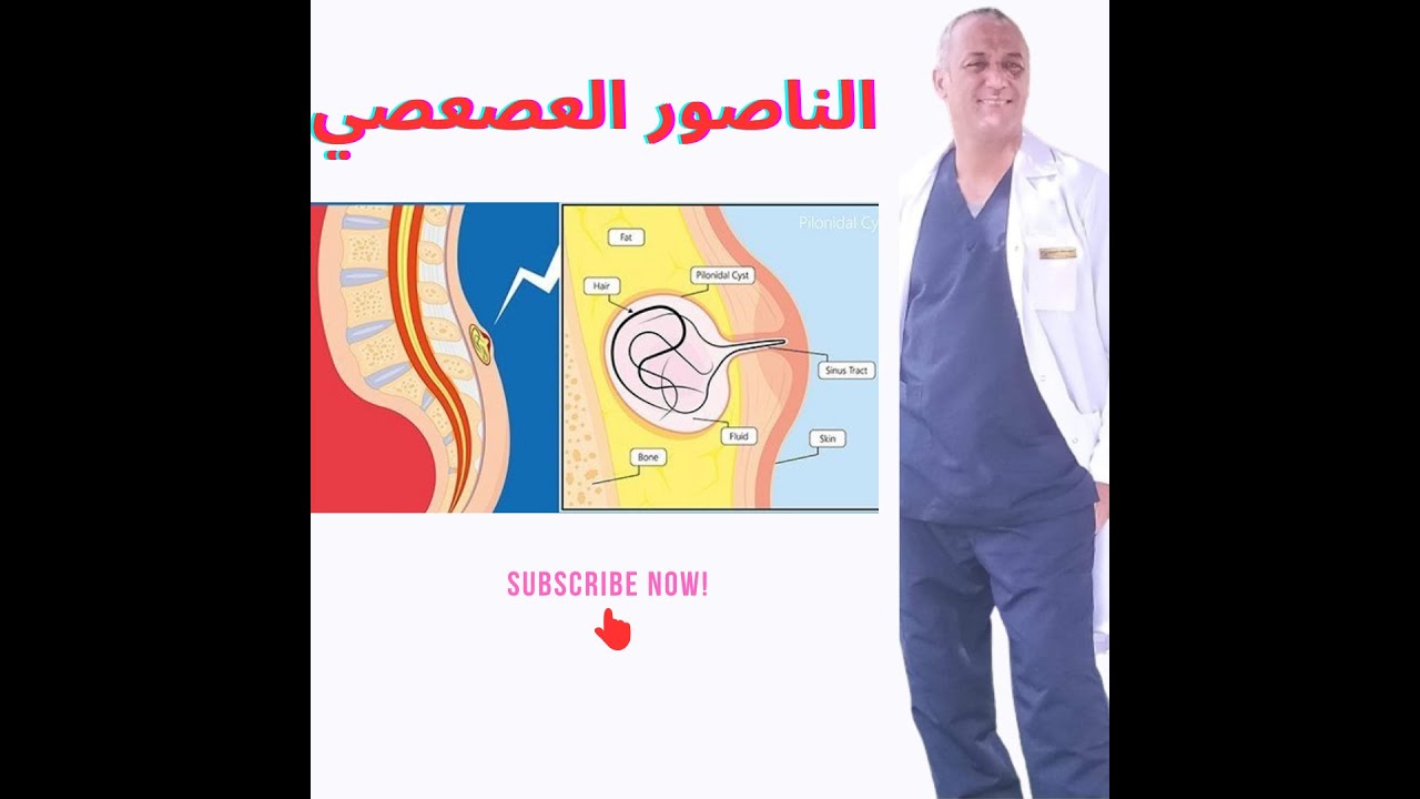 الناصور العصعصي - الخراج العصعصي pilonidal sinus pilonidal abscess#الجراح #جراحة_عامة