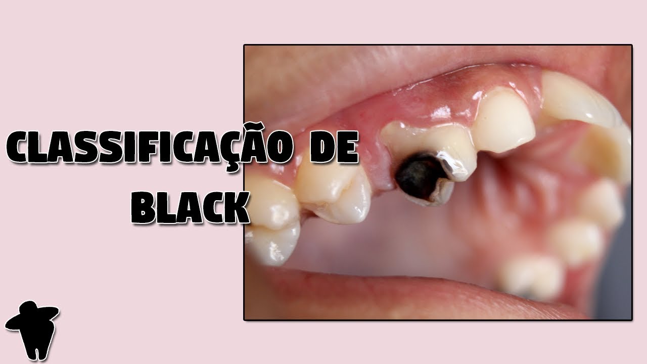 Classificação de Black - Nomenclatura e Classificação de Cavidades - Aula de Dentística [DE #15]
