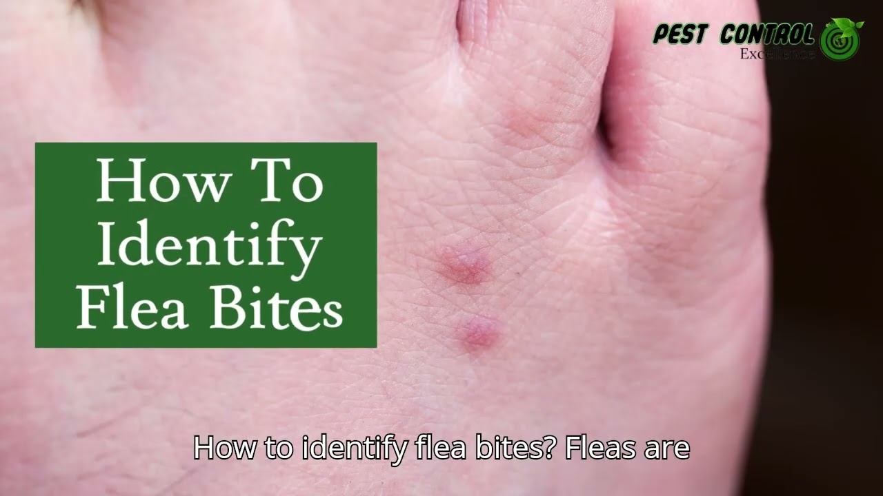 Flea Bites vs. Lice Bites: Know the Difference!