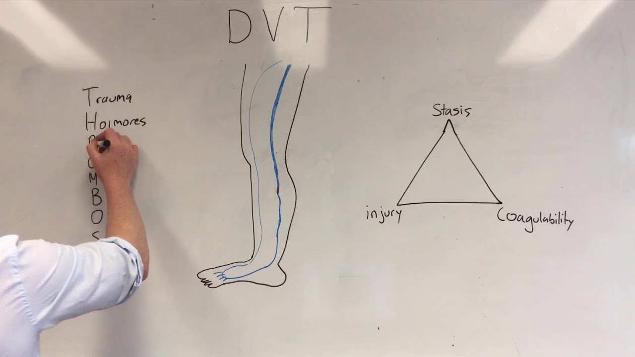 Exam Questions | Deep Vein Thrombosis
