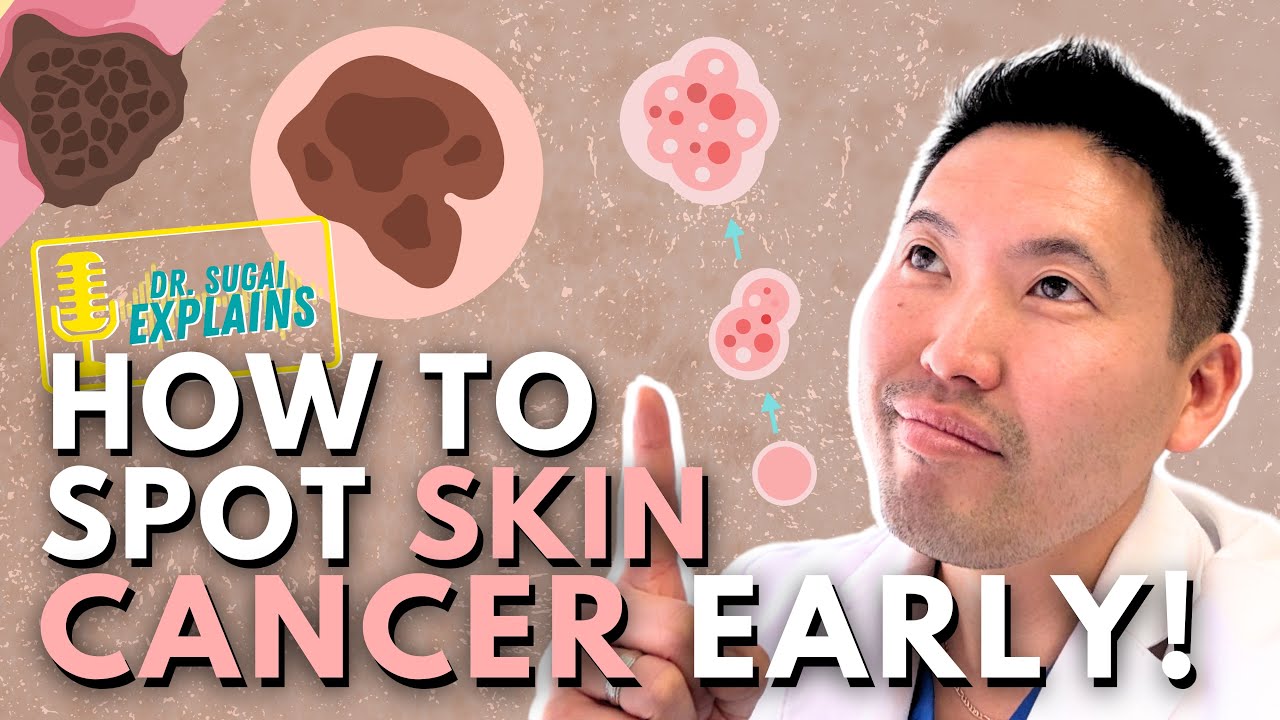 Dermatologist Explains: How To Spot Skin Cancer Early!
