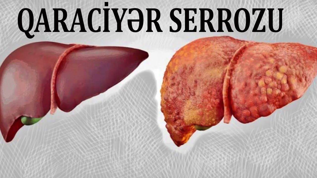 Qaraciyər serrozu necə müalicə edilir?