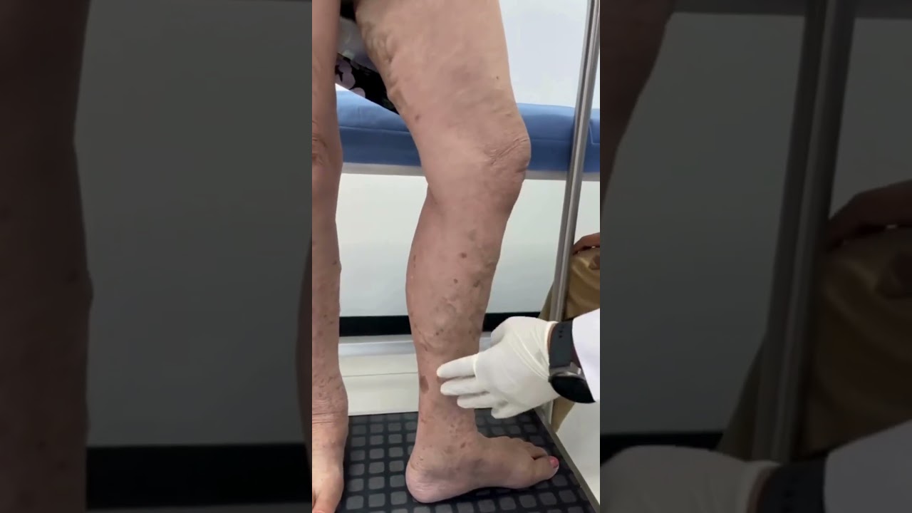 Várices, porqué tratarlas. Qué pasa si no atiendo las várices a tiempo