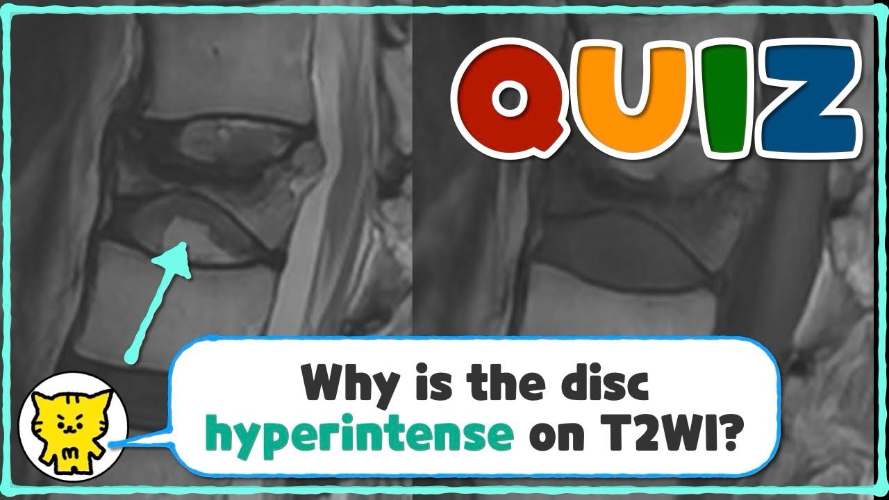 📌 For a patient with an acute compression fracture, why is the disc hyperintense on T2WI?